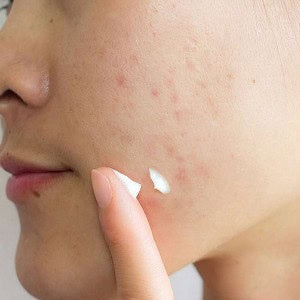 SKIN1004 Madagascar Centella Tea-Trica Spot Cream | Crema Calmante Anti-Imperfecciones (20 ml)