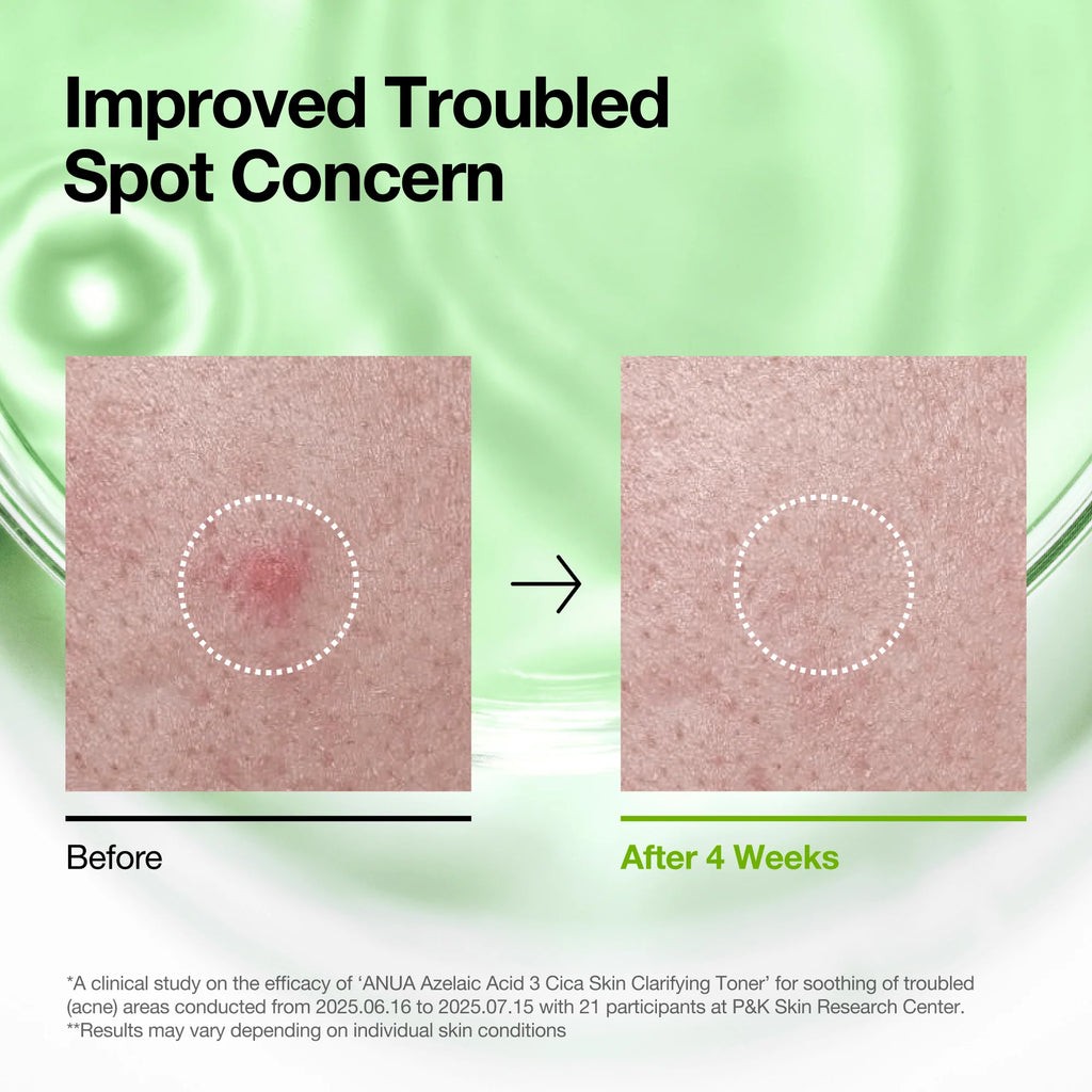 ANUA – Azelaic Acid 3 Cica Skin Clarifying Toner | Tónico Calmante y Regulador del Sebo